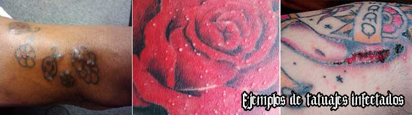 Tatuajes infectados y sobrehidratados
